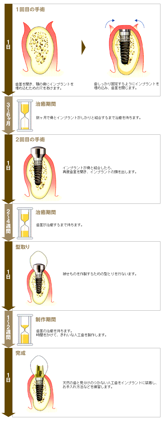 インプラント2回法の図解