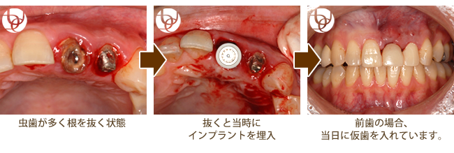 抜歯即時インプラント症例