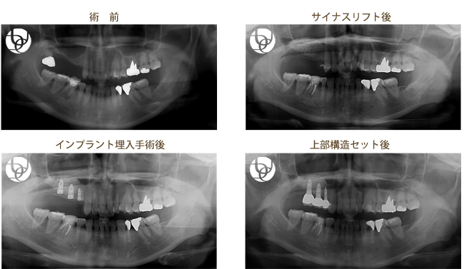サイナスリフト(上顎洞を挙上して骨を作る)を行ったケース