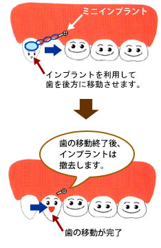 ミニインプラントを利用した矯正治療について