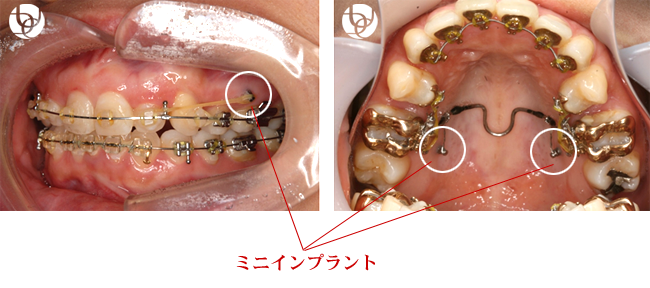 ミニインプラント矯正の症例