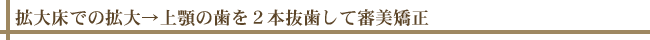 拡大床での拡大→上顎2の歯を2本抜歯して審美矯正
