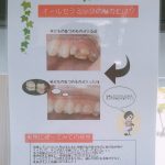 オールセラミックについて
