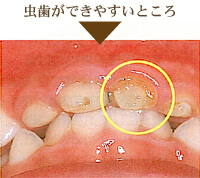 小児歯科のポイント