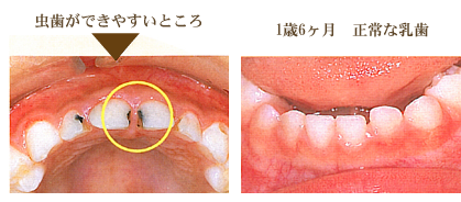 1歳6ヶ月の歯
