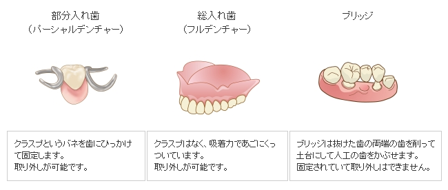 入れ歯・義歯図解