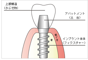インプラント