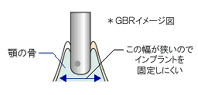 GBR法