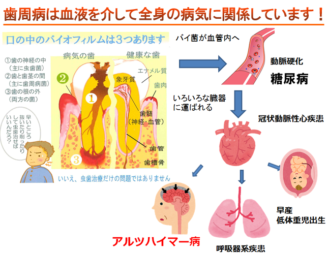 歯周病は万病のもと