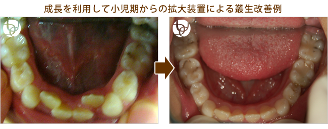 小児矯正歯科(歯列育形成):ガタガタ(叢生)改善例