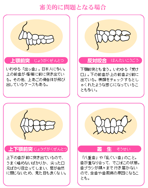 不正咬合の代表例:審美的に問題となる場合