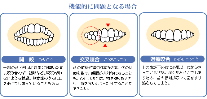 不正咬合の代表例:機能的に問題となる場合