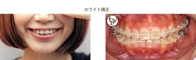 ホワイト矯正