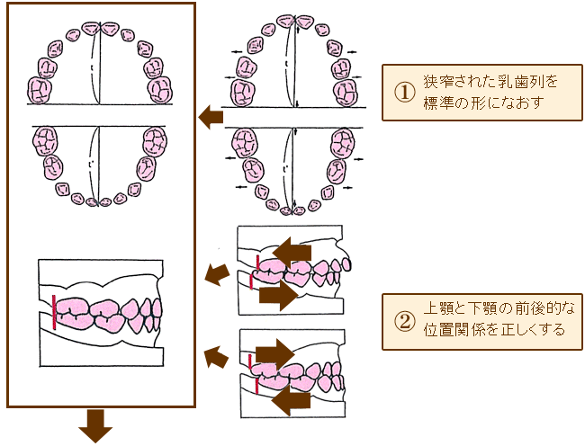 小児矯正1期治療及び歯列育成形の代表的な治療手順1・2