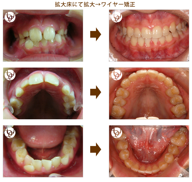 拡大床にて拡大→ワイヤー矯正