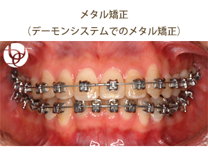 メタル矯正
