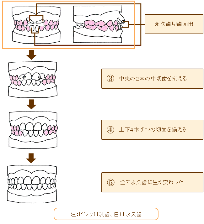 小児矯正1期治療及び歯列育成形の代表的な治療手順3・4・5