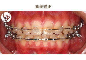 審美矯正
