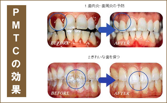 PMTCの効果