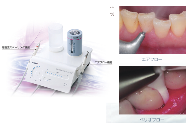 うえたに歯科式ワンランク上の最先端予防治療