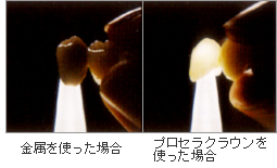 オールセラミック
