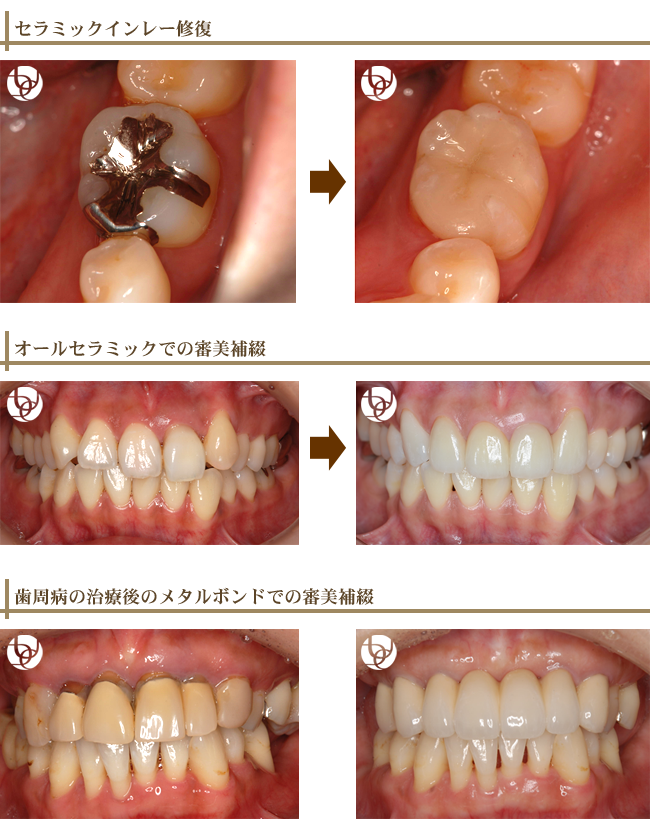 審美歯科症例