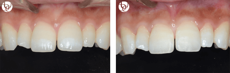 前歯の白濁・白斑修復 ICON（アイコン）治療
